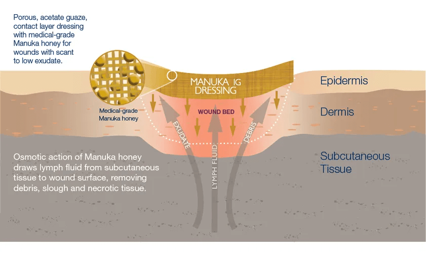 Manuka honey for burns and wounds