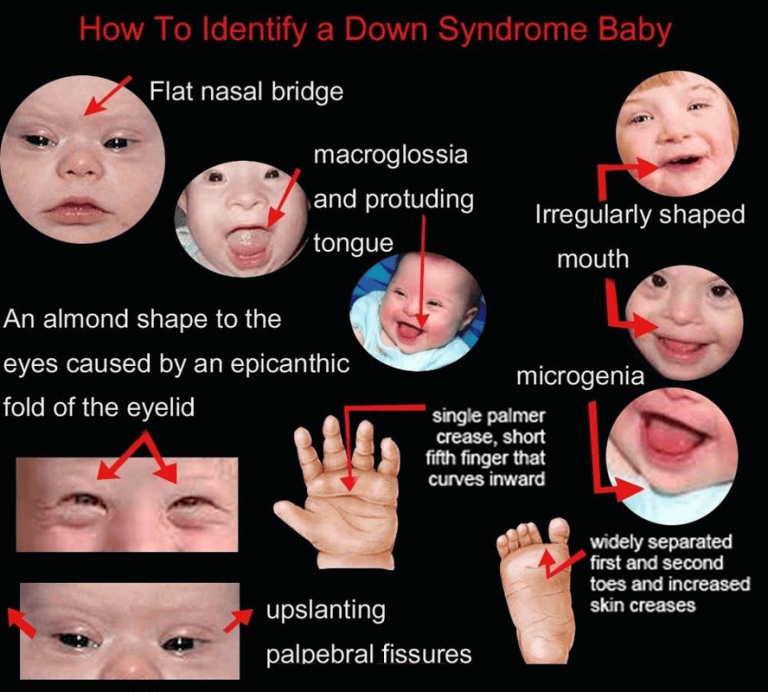 9-down-syndrome-facts-that-you-never-knew-just-credible