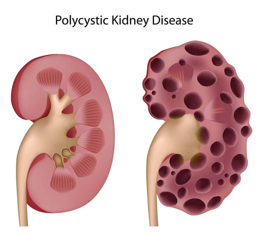 What is Polycystic Kidney Disease